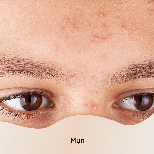 Với khả năng làm dịu mẩn đỏ, sưng tấy và viêm nhiễm, tinh dầu Tràm trà có thể giúp ngăn ngừa và giảm sẹo mụn trứng cá