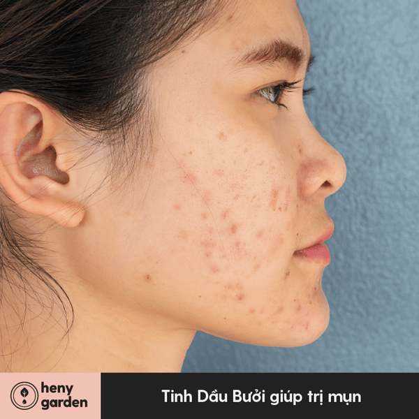 Tinh dầu bưởi góp phần mang lại làn da khỏe mạnh bằng cách ngăn ngừa và điều trị các bệnh về da như mụn trứng cá.