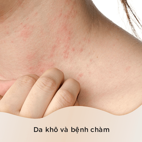 Tinh dầu cây tràm trà có thể giúp làm dịu da khô bằng cách giảm ngứa và kích ứng