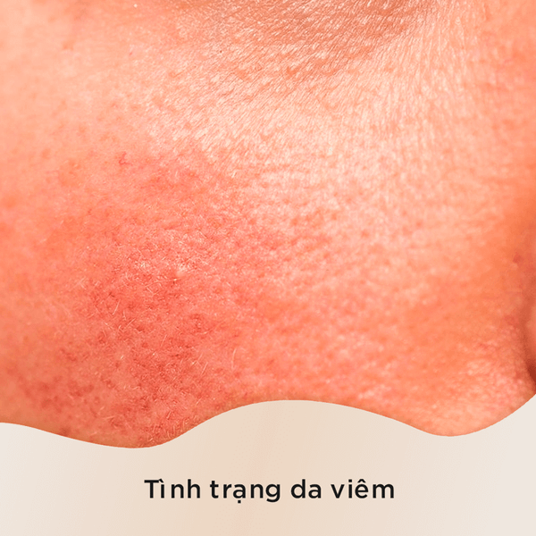 Tác dụng chống viêm của tinh dầu tràm trà giúp làm dịu tình trạng mẩn đỏ, sưng tấy và kích ứng da.