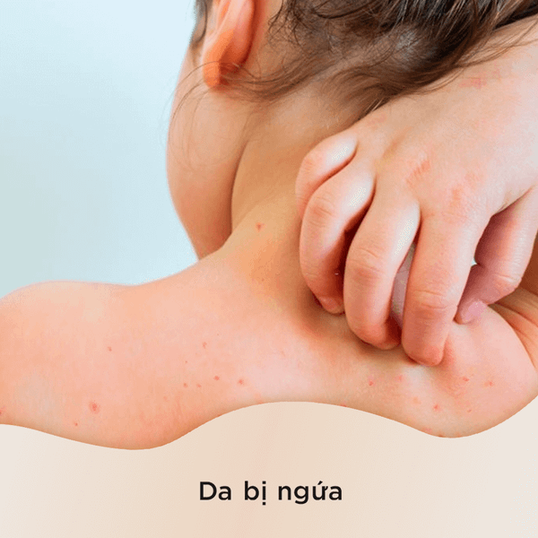 Nhờ vào đặc tính chống viêm của dầu cây tràm trà mà loại tinh dầu này rất hữu ích trong việc làm giảm sự khó chịu của da ngứa
