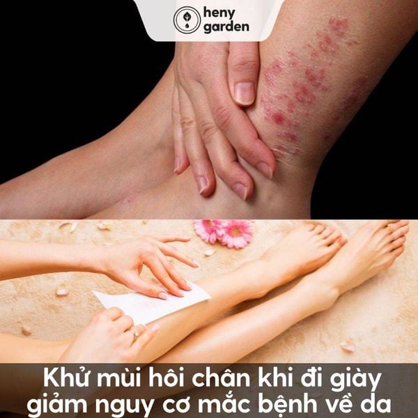 Khử mùi hôi chân khi đi giày giảm nguy cơ mắc bệnh về da