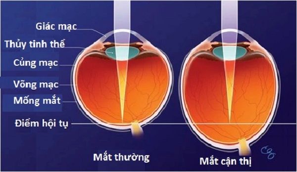 tại sao ko nên đọc sách nơi thiếu ánh sáng