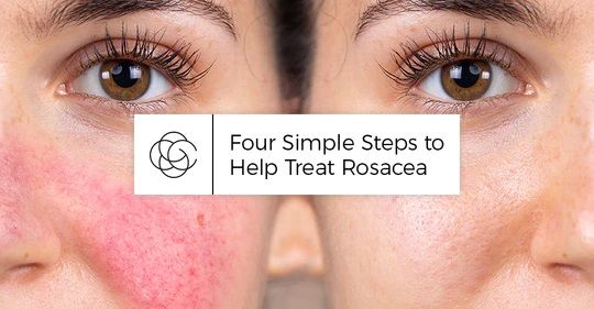 Bốn bước đơn giản để giúp điều trị Rosacea
