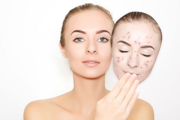Mụn trên da mặt: cách ngăn ngừa mụn hiệu quả