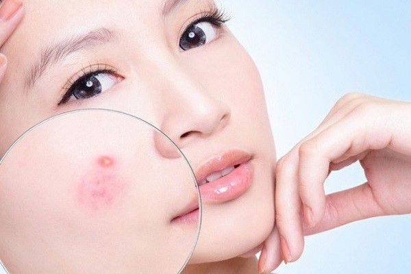 Mụn trên da mặt: cách ngăn ngừa mụn hiệu quả