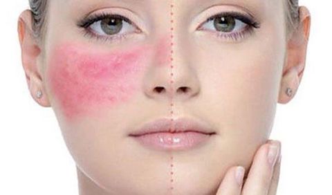 20 cách chữa dị ứng da mặt nhanh nhất mà bạn chưa biết