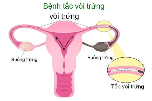 Tắc ứ dịch vòi trứng – mổ thông hay uống thuốc