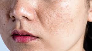 Nám da nội tiết sau sanh Mẹ Bỉm sữa phải làm sao