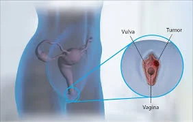 Ung thư âm hộ: Nguyên nhân, dấu hiệu, chẩn đoán và điều trị