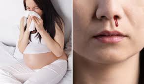 Mẹ Bầu chảy máu cam, có nguy hiểm không?