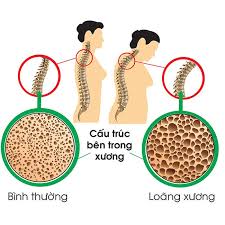 Loãng xương là gì những điều bạn cần biết?