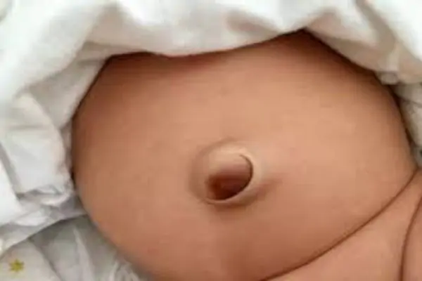 Rốn lồi ở trẻ sơ sinh