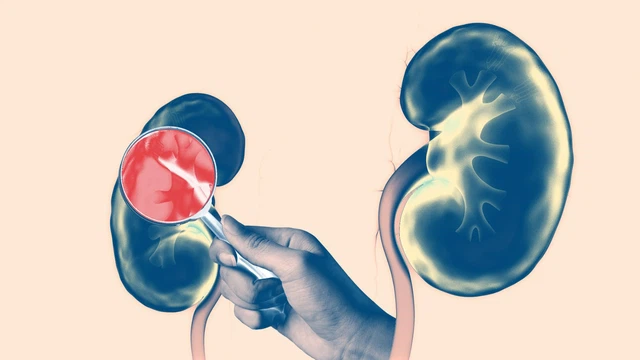 Viêm cầu thận tiến triển nhanh (RPGN) là gì? Nguyên nhân, triệu chứng và cách điều trị