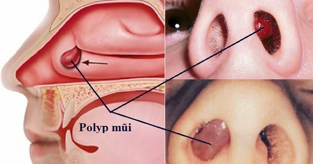 U hốc mũi là gì?