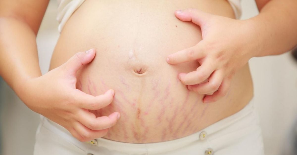 Da rạn, da sẫm, thâm da – 13 thực phẩm bổ sung collagen dành cho Mẹ bầu và Mẹ bỉm sữa phục hồi da