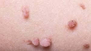 Tự điều trị khi bị mụn thịt sau sanh