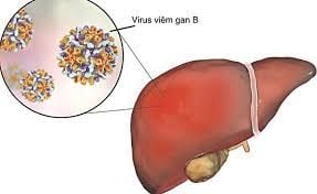 Mẹ Bầu bị Viêm Gan B ảnh hưởng bé ra sao?