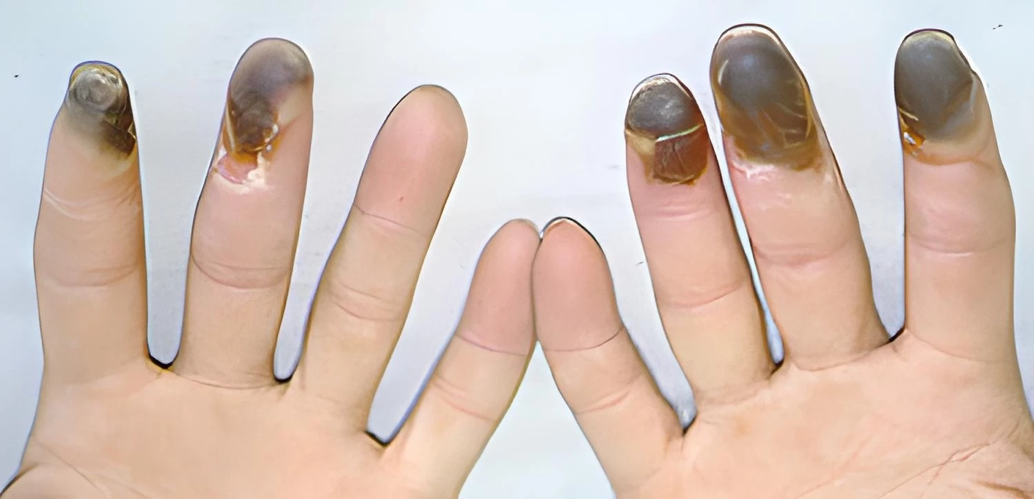 Bệnh Buerger là gì?
