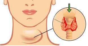 Suy giáp: Bệnh rối loạn hormone phổ biến và các phương pháp điều trị