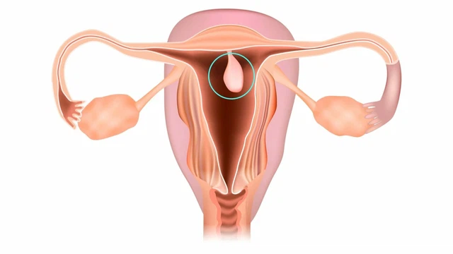Polyp buồng tử cung là gì?
