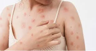 Phát ban ở ngực (vú) là gì? Nguyên nhân, chẩn đoán và điều trị phát ban ở ngực