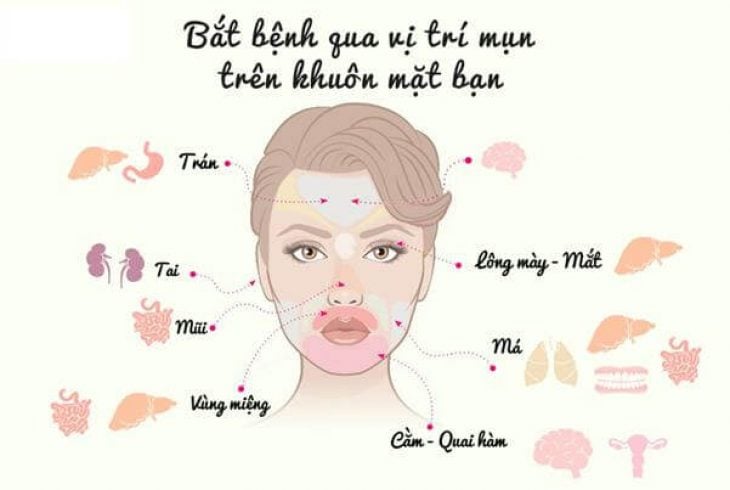 Mụn rối loạn nội tiết