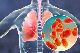Nhiễm nấm Histoplasma là bệnh gì? Dấu hiệu nhận biết, nguyên nhân và cách phòng ngừa