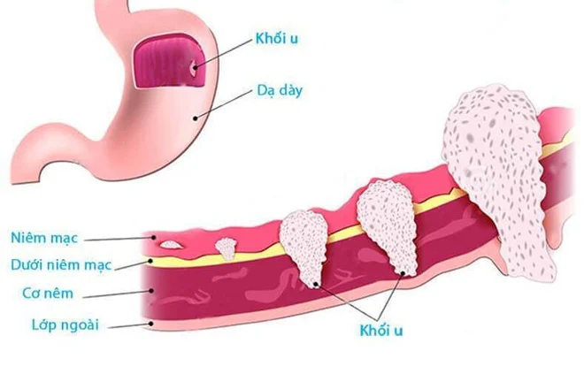 Ung thư dạ dày di căn: Triệu chứng, chẩn đoán và điều trị
