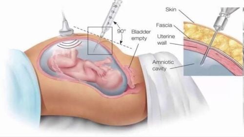 Chọc Ối Được Thực Hiện Như Thế Nào? Có Đau Không?