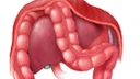 Hội chứng Chilaiditi và những điều cần biết