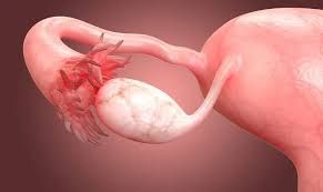 [Giải đáp] Ung thư buồng trứng sống được bao lâu và cách kéo dài