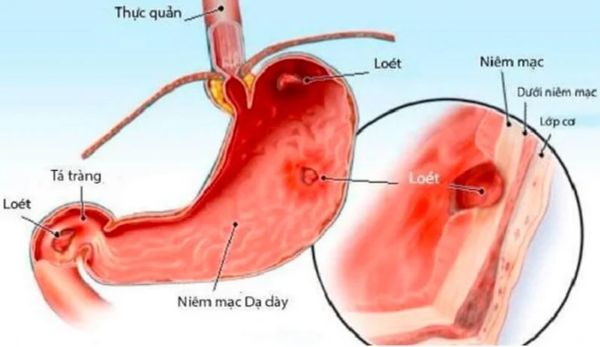 Ung thư dạ dày và thông tin cần biết