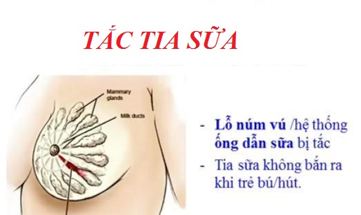 Tắc tia sữa sau sinh làm sao hết?