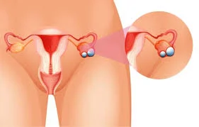 Trọn bộ thông tin về ung thư buồng trứng giai đoạn đầu