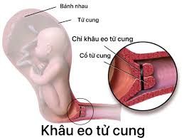 Khâu eo tử cung, đặt vòng nâng nếu cổ tử cung ngắn khi nào?