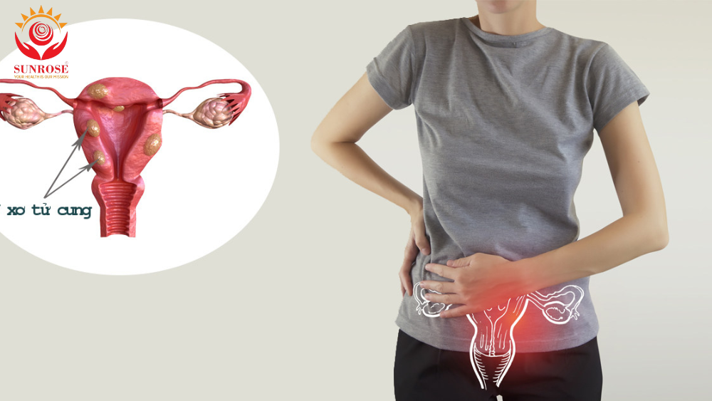 U xơ tử cung: Các trường hợp có chỉ định phẫu thuật