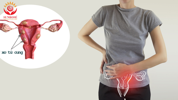 U xơ tử cung: Các trường hợp có chỉ định phẫu thuật