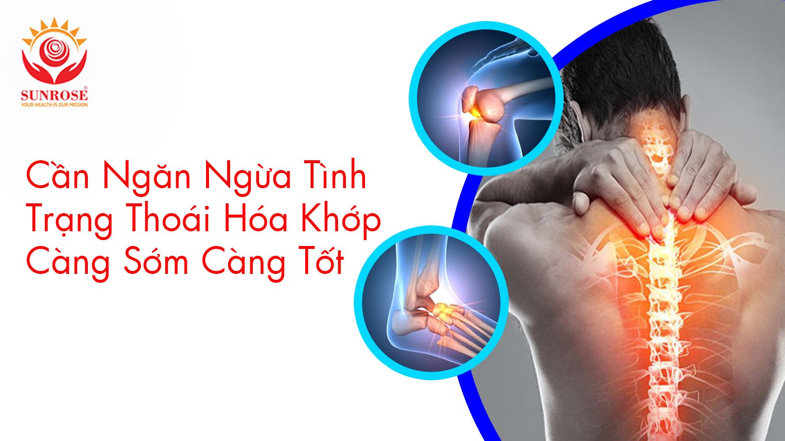 Cần Ngăn Ngừa Tình Trạng Thoái Hóa Khớp Càng Sớm Càng Tốt