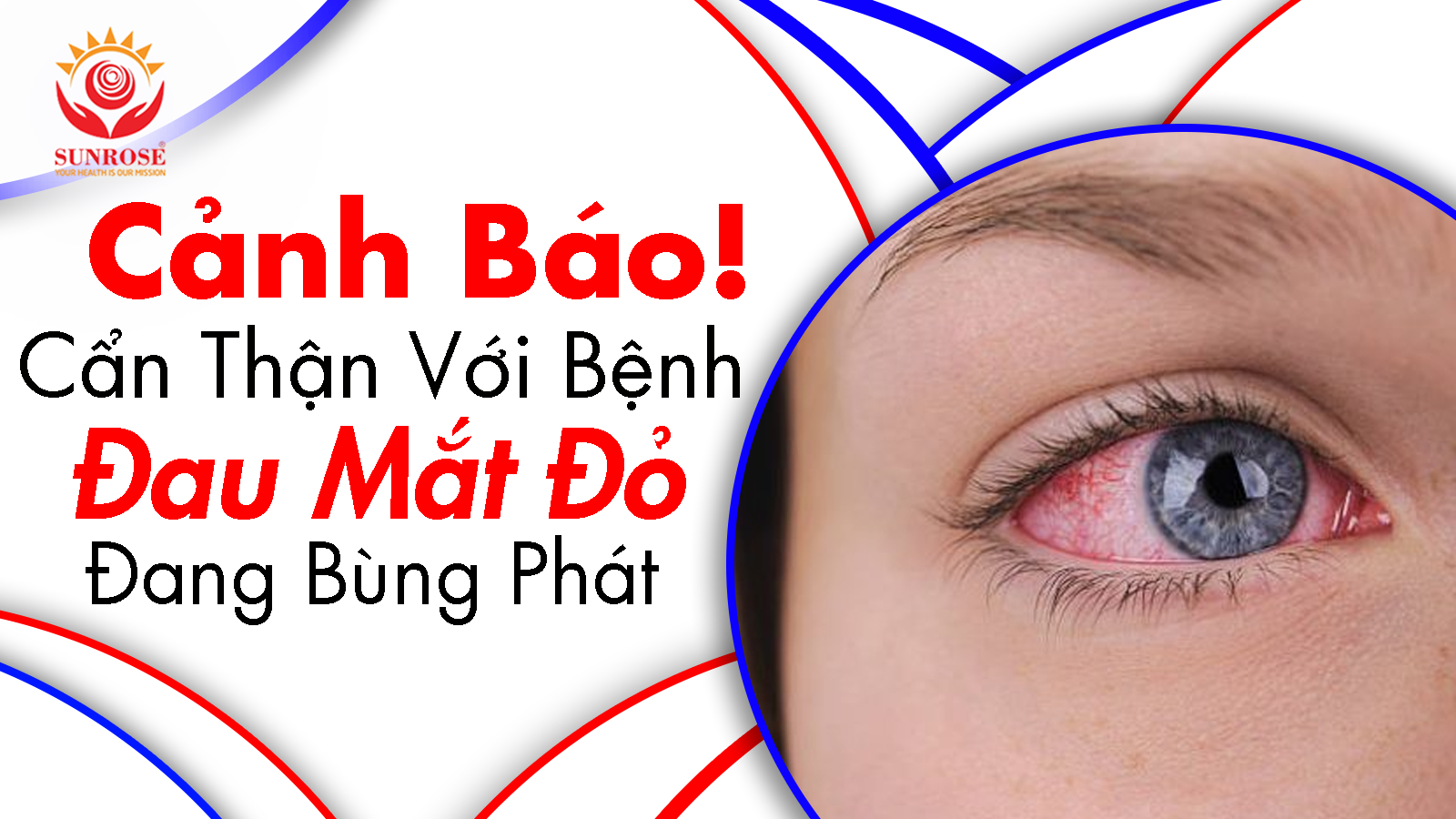 Cảnh Báo! Cẩn Thận Với Bệnh Đau Mắt Đỏ Đang Bùng Phát