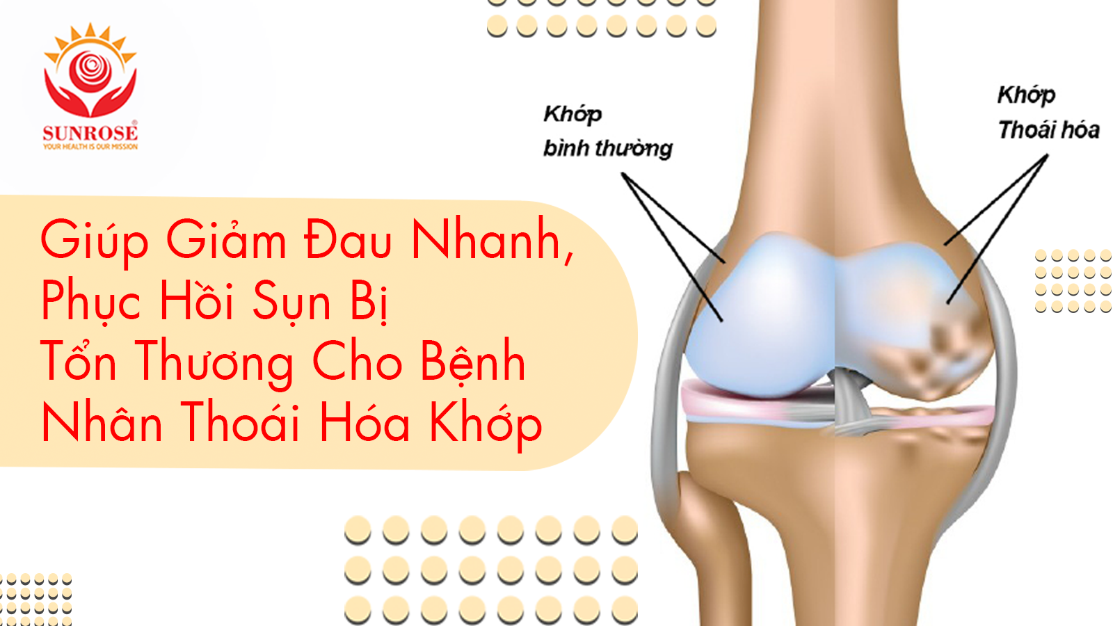 Giúp Giảm Đau Nhanh, Phục Hồi Sụn Bị Tổn Thương Cho Bệnh Nhân Thoái Hóa Khớp