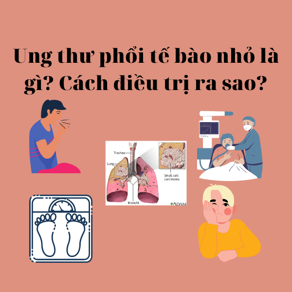 Ung thư phổi tế bào nhỏ là gì? Cách điều trị ra sao?