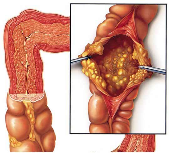 VIÊM ĐẠI TRÀNG: NGUYÊN NHÂN, TRIỆU CHỨNG, CHẨN ĐOÁN, ĐIỀU TRỊ