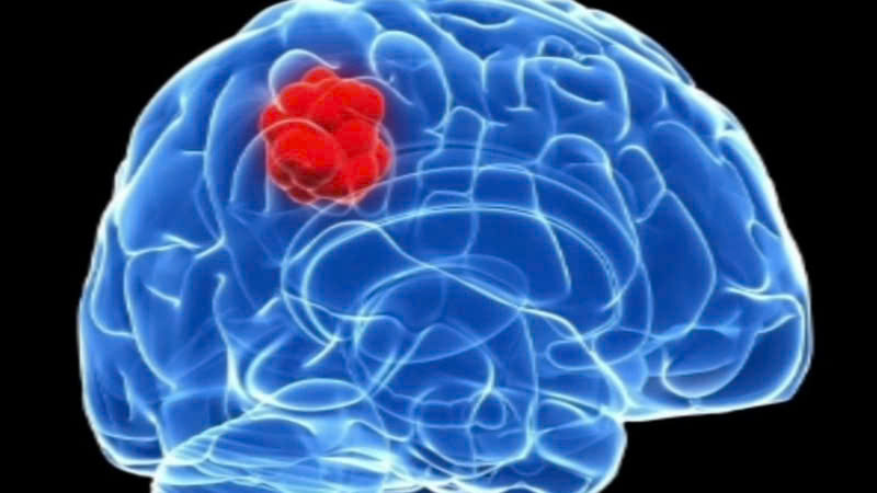 Khám u não ở đâu uy tín và chất lượng tại TP. Hồ Chí Minh?