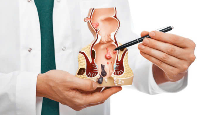 Địa chỉ cắt trĩ ở đâu tốt nhất Hà Nội?