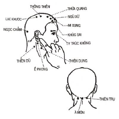 Ù tai sau sanh, chữa khỏi đơn giản bằng bấm huyệt