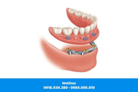 Bệnh Nhân Nào Nên Thực Hiện Phương Pháp Cấy Ghép Răng?