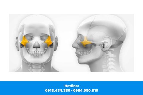 Cấy Ghép Implant Xương Gò Má (Zygoma Implants) Là Gì?