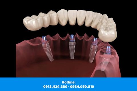 Cấy Ghép Răng All – On – 4 All – On – 6 Là Gì?