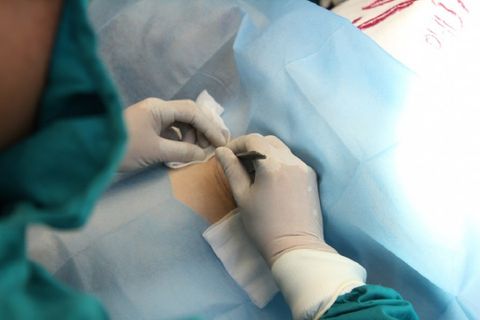 CẮT TUYẾN MỒ HÔI LIỆU CÓ CÒN LÀ PHƯƠNG PHÁP TỐI ƯU?